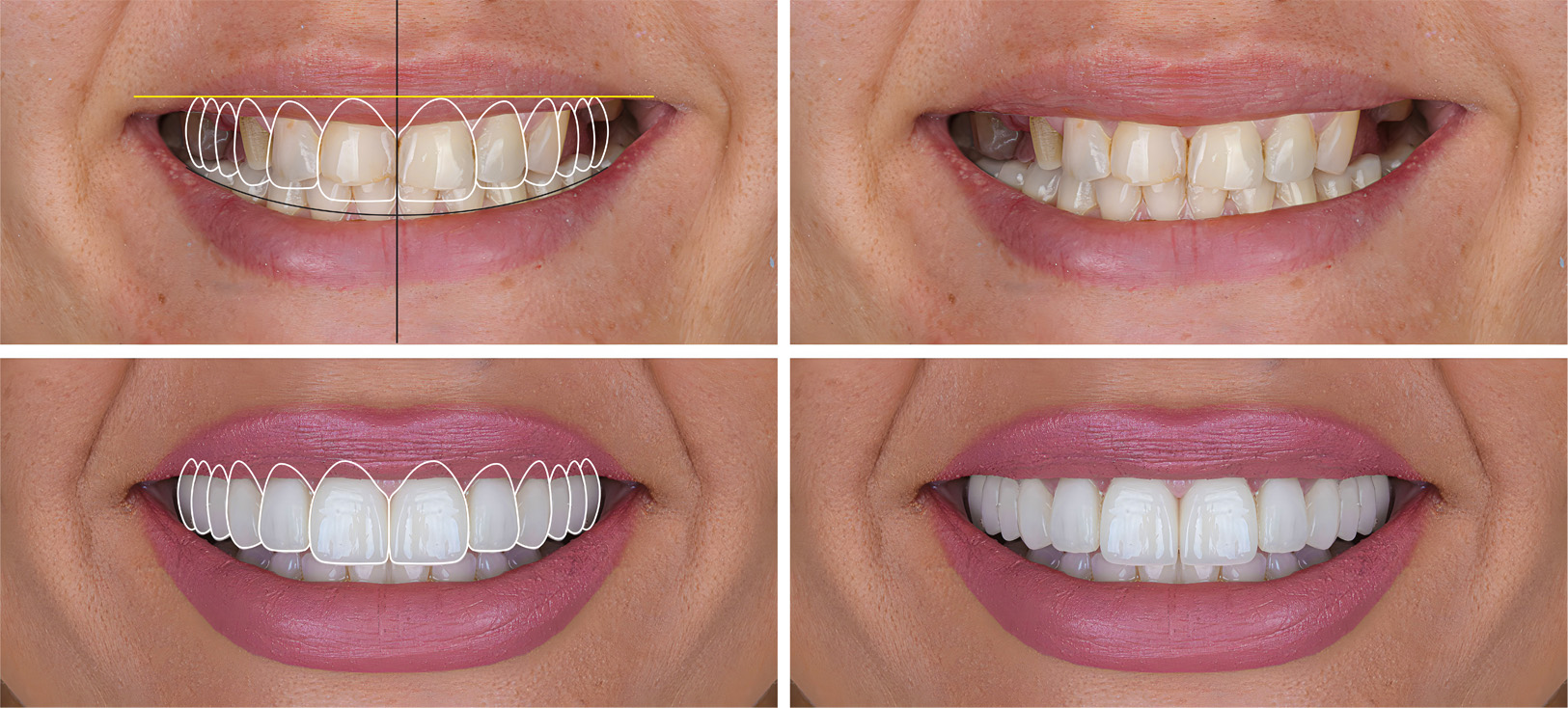 Marino Family Dental | Invisalign reg , Periodontal Treatment and Hollywood Porcelain Veneer Smile Transformations