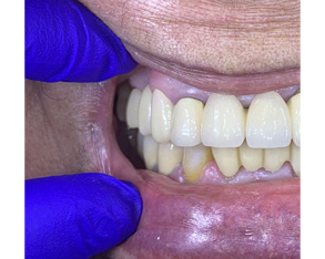 Marino Family Dental | Implant Dentistry, Cosmetic Dentistry and Preventative Program