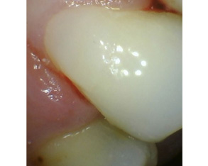 Marino Family Dental | Restorative Treatments, Veneers and Teeth Whitening