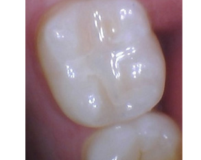 Marino Family Dental | Veneers, Preventative Program and Family Dentistry