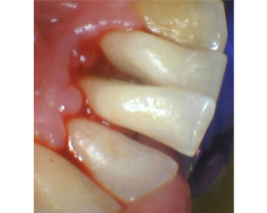 Marino Family Dental | Extractions, Veneers and Restorative Treatments