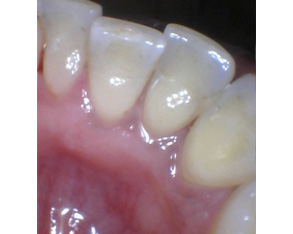 Marino Family Dental | Cosmetic Dentistry, Restorative Treatments and Extractions