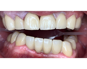 Marino Family Dental | Dentures, Hollywood Porcelain Veneer Smile Transformations and Dental Bridges