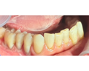 Marino Family Dental | Extractions, Cosmetic Dentistry and Dental Cleanings