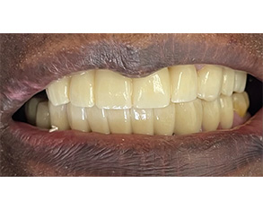 Marino Family Dental | Dental Fillings, Dental Bridges and Dental Cleanings