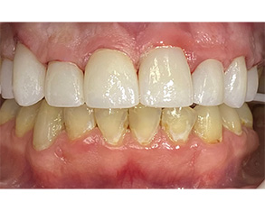 Marino Family Dental | Professional Denture Cleanings, Emergency Treatment and ClearCorrect®