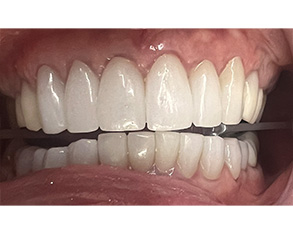 Marino Family Dental | ClearCorrect®, Ceramic Crowns and Sedation Dentistry