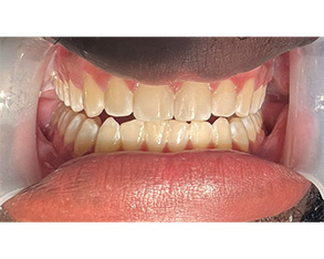 Marino Family Dental | ClearCorrect®, Cosmetic Dentistry and Dental Bridges