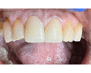 Marino Family Dental | Emergency Treatment, Implant Dentistry and Invisalign®