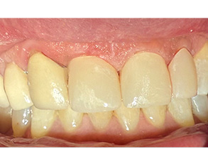 Marino Family Dental | Family Dentistry, Dental Cleanings and Professional In-Office Teeth Whitening