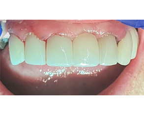 Marino Family Dental | Oral Exams, Dentures and Hollywood Porcelain Veneer Smile Transformations