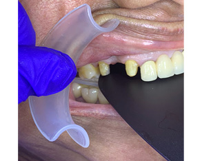 Marino Family Dental | Sedation Dentistry, Veneers and Preventative Program