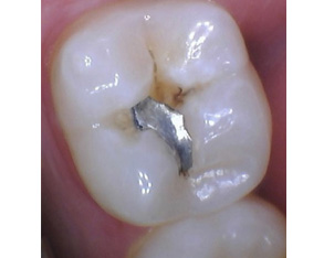 Marino Family Dental | Restorative Treatments, Sedation Dentistry and Implant Dentistry