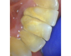 Marino Family Dental | Cosmetic Dentistry, Veneers and Family Dentistry