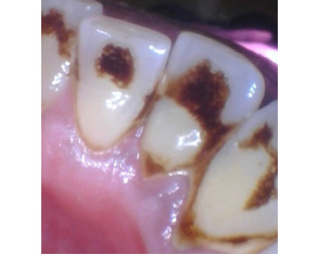 Marino Family Dental | Extractions, Emergency Treatment and Restorative Treatments