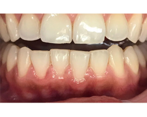 Marino Family Dental | Family Dentistry, Implant Dentistry and Veneers