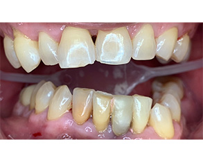 Marino Family Dental | Periodontal Treatment, Dental Bridges and Dental Cleanings