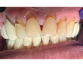 Marino Family Dental | Professional Denture Cleanings, Invisalign® and Oral Exams