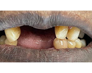 Marino Family Dental | Restorative Treatments, Invisalign® and Emergency Treatment