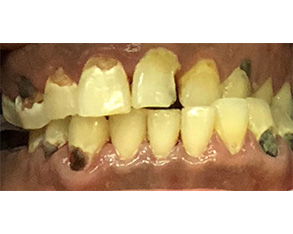 Marino Family Dental | Restorative Treatments, Periodontal Treatment and Professional In-Office Teeth Whitening