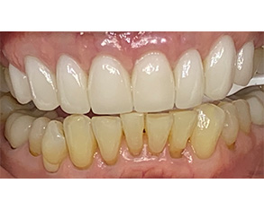 Marino Family Dental | Dental Bridges, Ceramic Crowns and ClearCorrect®