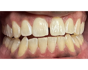 Marino Family Dental | Professional In-Office Teeth Whitening, Implant Dentistry and Restorative Treatments