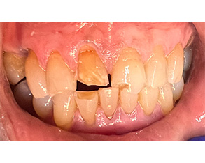 Marino Family Dental | Hollywood Porcelain Veneer Smile Transformations, Periodontal Treatment and Emergency Treatment