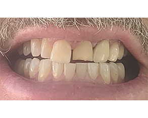 Marino Family Dental | ClearCorrect®, Oral Surgery and Root Canals