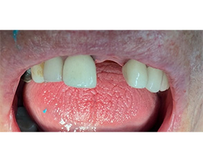 Marino Family Dental | Hollywood Porcelain Veneer Smile Transformations, Restorative Treatments and Extractions