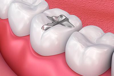 Marino Family Dental | Oral Exams, Preventative Program and Veneers