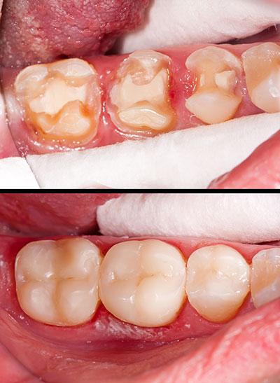 Marino Family Dental | Emergency Treatment, Veneers and Extractions