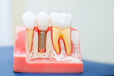 Marino Family Dental | Veneers, Sedation Dentistry and Implant Dentistry