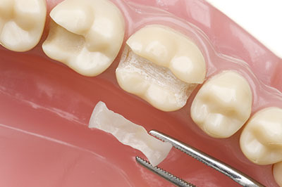 Marino Family Dental | Implant Dentistry, Cosmetic Dentistry and Veneers