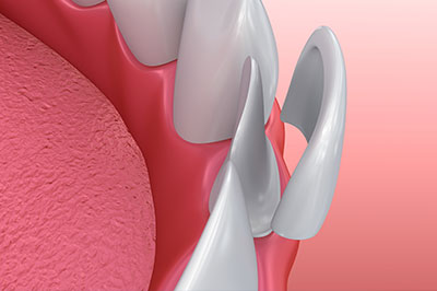Marino Family Dental | Preventative Program, Family Dentistry and Restorative Treatments