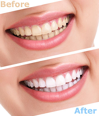 Marino Family Dental | Preventative Program, Teeth Whitening and Cosmetic Dentistry